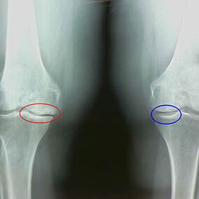 Arthrosis knee joint on the radiograph