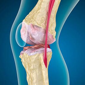 Excessive tension of the muscles from the thigh causes the pain in the knee